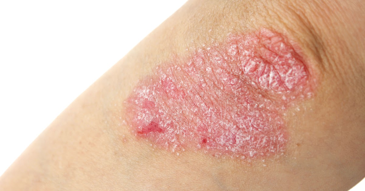 Zirtek de atopicheskogo de la dermatitis las revocaciones